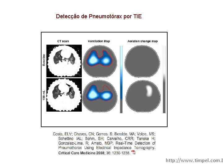 Detecção de Pneumotórax por TIE http: //www. timpel. com. b 