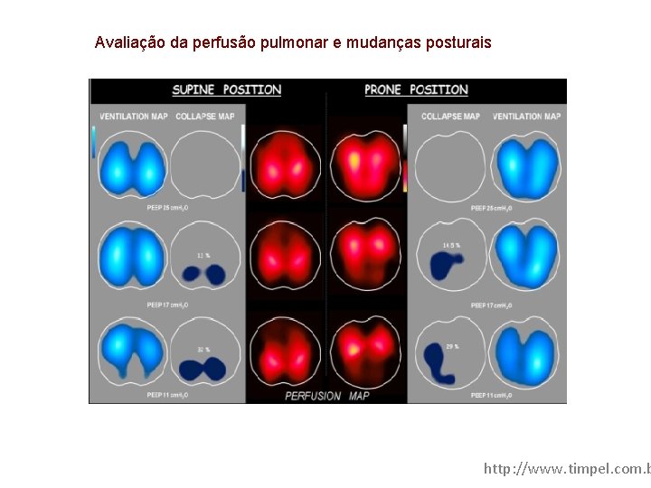 Avaliação da perfusão pulmonar e mudanças posturais http: //www. timpel. com. b 