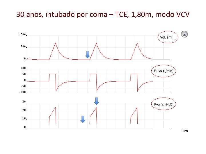 30 anos, intubado por coma – TCE, 1, 80 m, modo VCV 