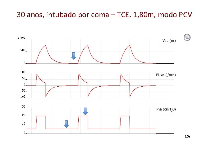 30 anos, intubado por coma – TCE, 1, 80 m, modo PCV 