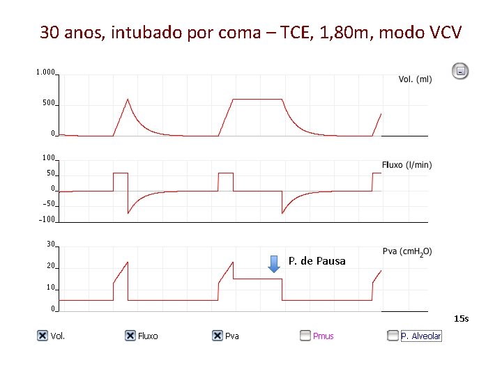 30 anos, intubado por coma – TCE, 1, 80 m, modo VCV p P.