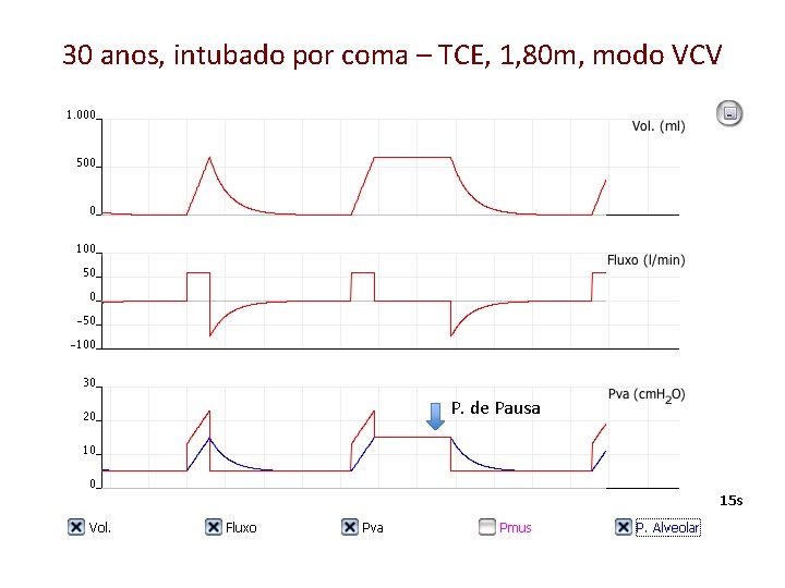 30 anos, intubado por coma – TCE, 1, 80 m, modo VCV P. de