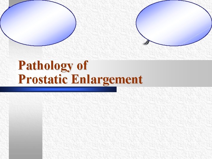 Pathology of Prostatic Enlargement Pathology of Prostatic Enlargement