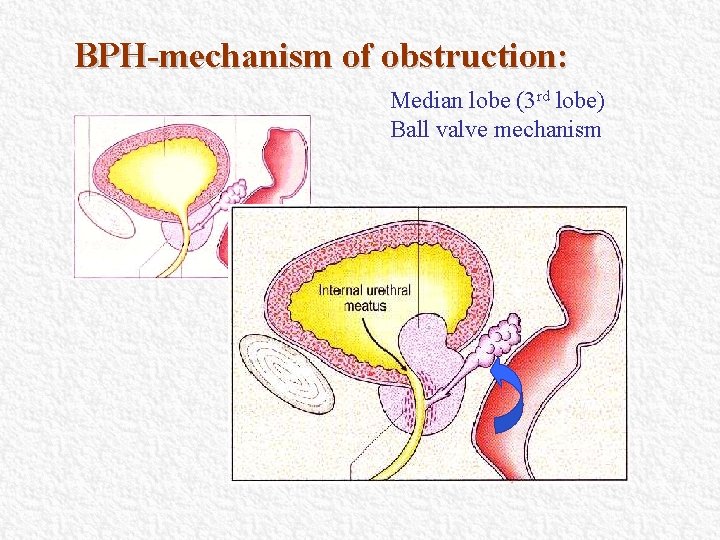 BPH-mechanism of obstruction: Median lobe (3 rd lobe) Ball valve mechanism BPH-mechanism of obstruction: Median lobe (3 rd lobe) Ball valve mechanism