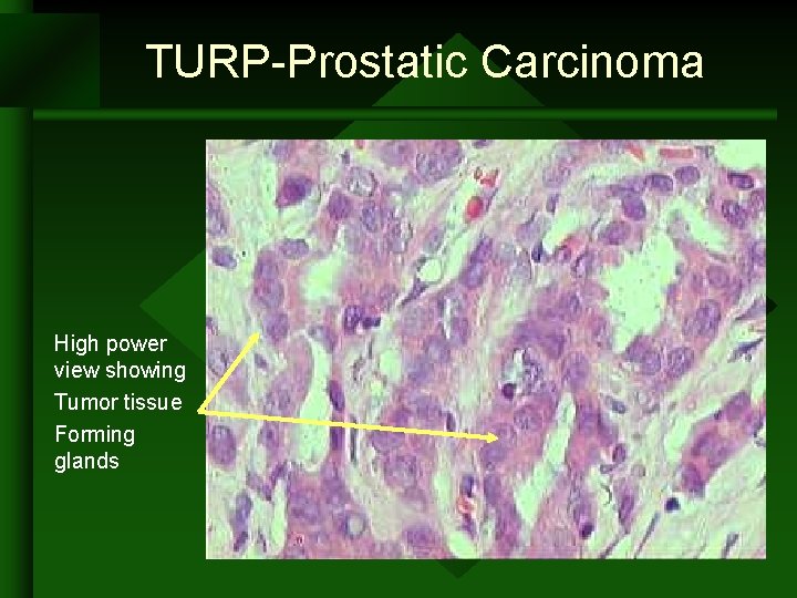 TURP-Prostatic Carcinoma High power view showing Tumor tissue Forming glands TURP-Prostatic Carcinoma High power view showing Tumor tissue Forming glands