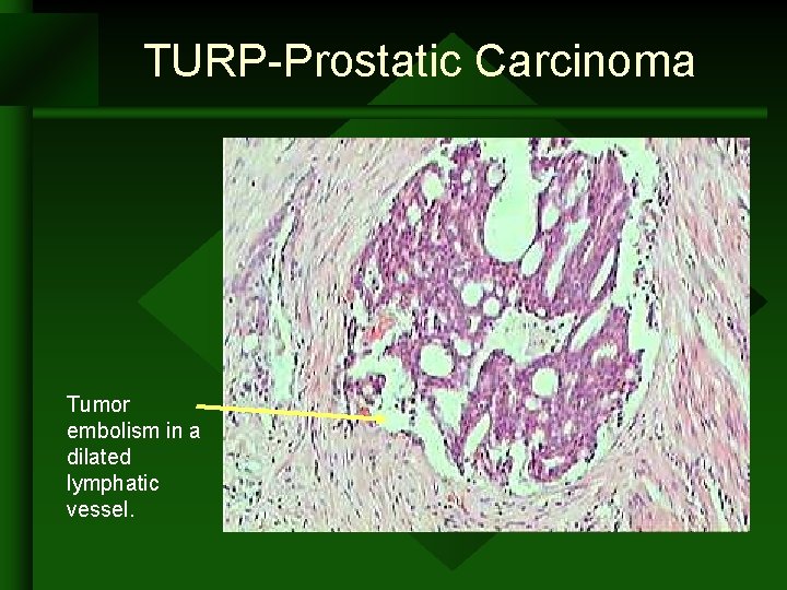 TURP-Prostatic Carcinoma Tumor embolism in a dilated lymphatic vessel. TURP-Prostatic Carcinoma Tumor embolism in a dilated lymphatic vessel.