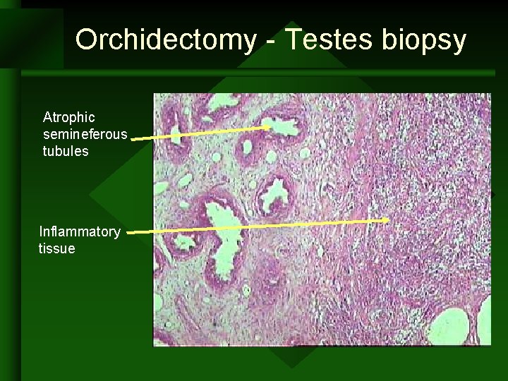 Orchidectomy - Testes biopsy Atrophic semineferous tubules Inflammatory tissue Orchidectomy - Testes biopsy Atrophic semineferous tubules Inflammatory tissue