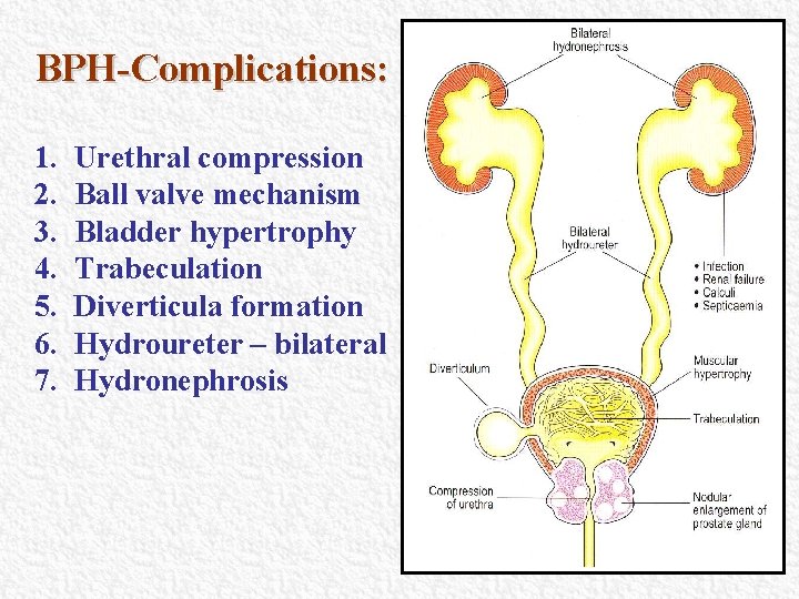BPH-Complications: 1. 2. 3. 4. 5. 6. 7. Urethral compression Ball valve mechanism Bladder BPH-Complications: 1. 2. 3. 4. 5. 6. 7. Urethral compression Ball valve mechanism Bladder