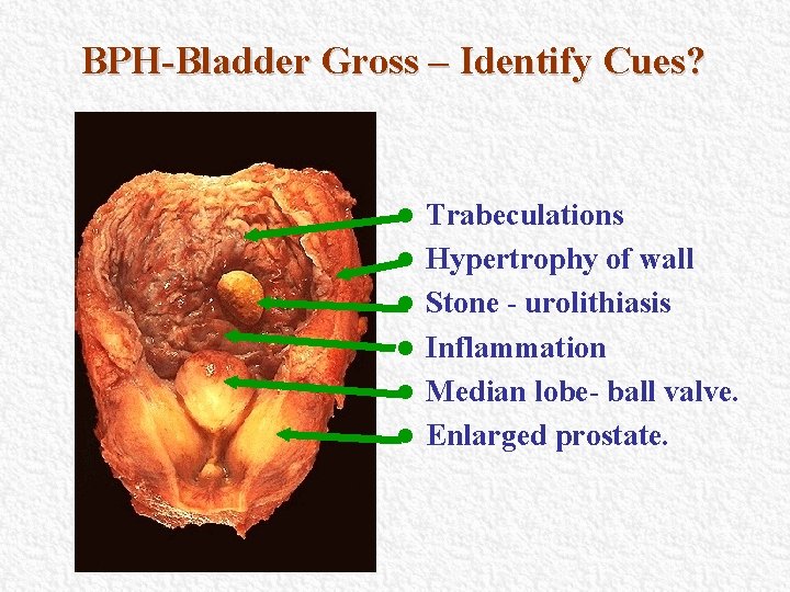 BPH-Bladder Gross – Identify Cues? l l l Trabeculations Hypertrophy of wall Stone - BPH-Bladder Gross – Identify Cues? l l l Trabeculations Hypertrophy of wall Stone -