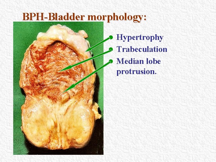 BPH-Bladder morphology: Hypertrophy l Trabeculation l Median lobe protrusion. l BPH-Bladder morphology: Hypertrophy l Trabeculation l Median lobe protrusion. l