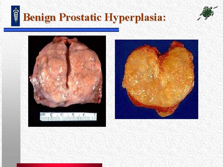 Benign Prostatic Hyperplasia: Benign Prostatic Hyperplasia: