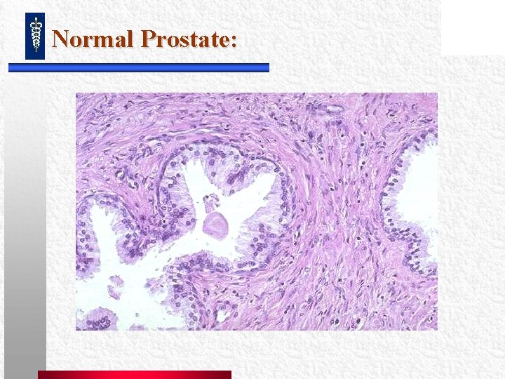 Normal Prostate: Normal Prostate: