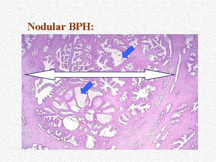 Nodular BPH: Nodular BPH:
