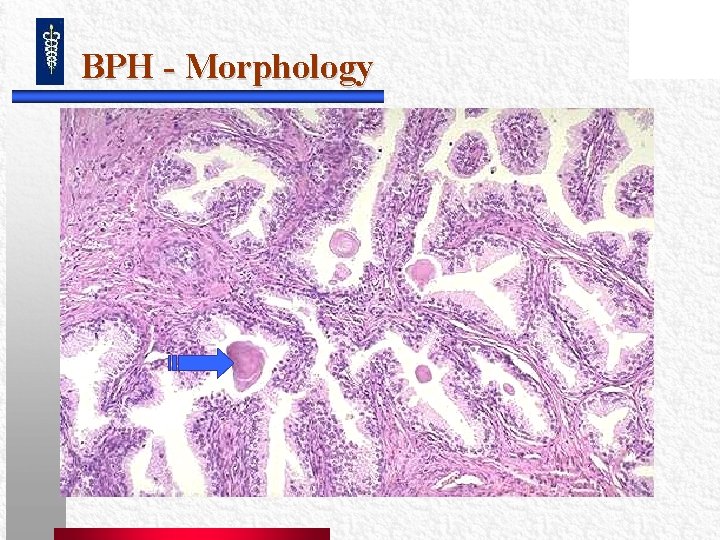 BPH - Morphology BPH - Morphology