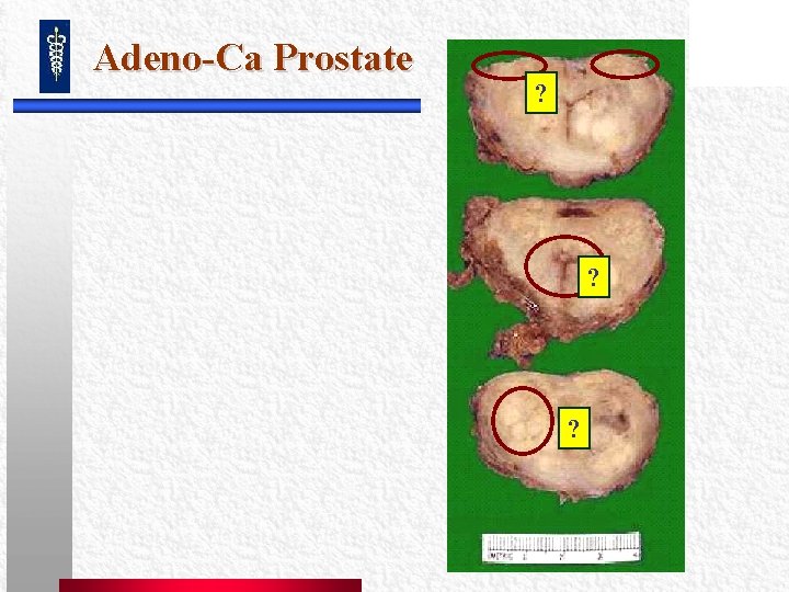 Adeno-Ca Prostate ? ? ? Adeno-Ca Prostate ? ? ?
