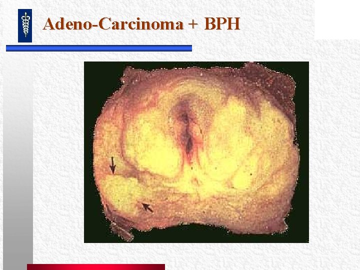 Adeno-Carcinoma + BPH Adeno-Carcinoma + BPH