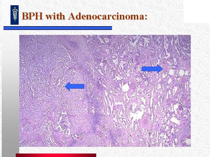 BPH with Adenocarcinoma: BPH with Adenocarcinoma: