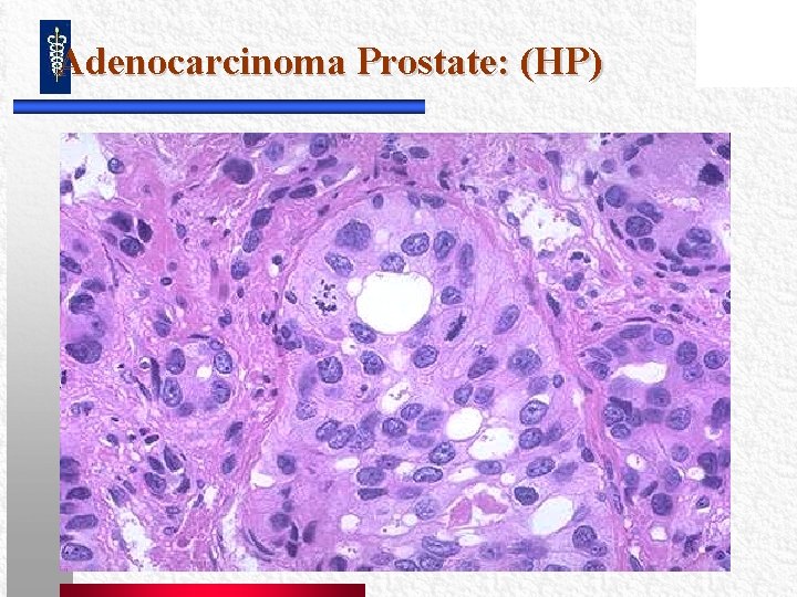 Adenocarcinoma Prostate: (HP) Adenocarcinoma Prostate: (HP)