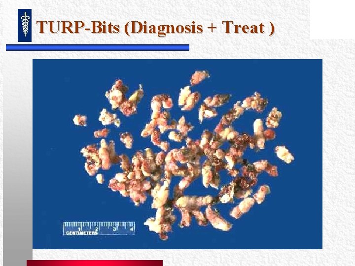 TURP-Bits (Diagnosis + Treat ) TURP-Bits (Diagnosis + Treat )