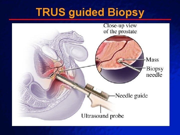 Slide 33 © 2003 By Default! TRUS guided Biopsy A Free sample background from Slide 33 © 2003 By Default! TRUS guided Biopsy A Free sample background from