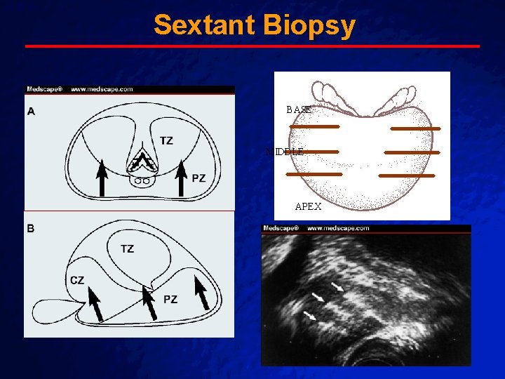 Slide 34 Sextant Biopsy BASE MIDDLE APEX A Free sample background from www. powerpointbackgrounds. Slide 34 Sextant Biopsy BASE MIDDLE APEX A Free sample background from www. powerpointbackgrounds.