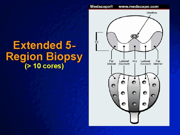Slide 35 © 2003 By Default! Extended 5 Region Biopsy (> 10 cores) A Slide 35 © 2003 By Default! Extended 5 Region Biopsy (> 10 cores) A