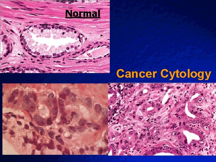 Slide 38 © 2003 By Default! Normal Cancer Cytology A Free sample background from Slide 38 © 2003 By Default! Normal Cancer Cytology A Free sample background from