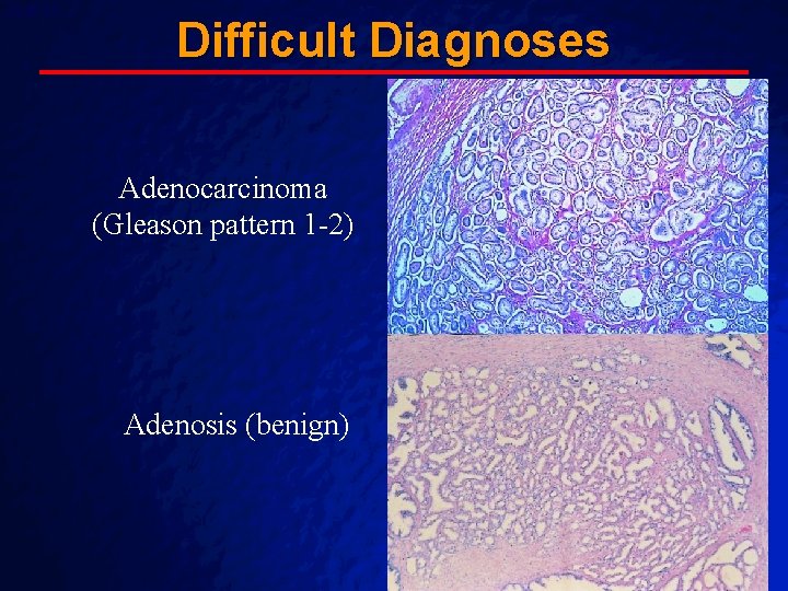 Slide 40 Difficult Diagnoses Adenocarcinoma (Gleason pattern 1 -2) Adenosis (benign) A Free sample Slide 40 Difficult Diagnoses Adenocarcinoma (Gleason pattern 1 -2) Adenosis (benign) A Free sample