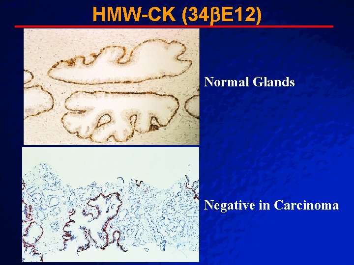 Slide 48 HMW-CK (34 E 12) © 2003 By Default! Normal Glands Negative in Slide 48 HMW-CK (34 E 12) © 2003 By Default! Normal Glands Negative in