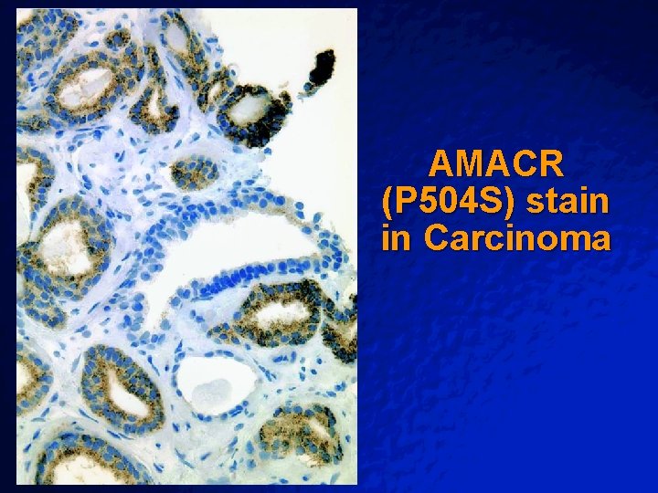 Slide 49 © 2003 By Default! AMACR (P 504 S) stain in Carcinoma A Slide 49 © 2003 By Default! AMACR (P 504 S) stain in Carcinoma A