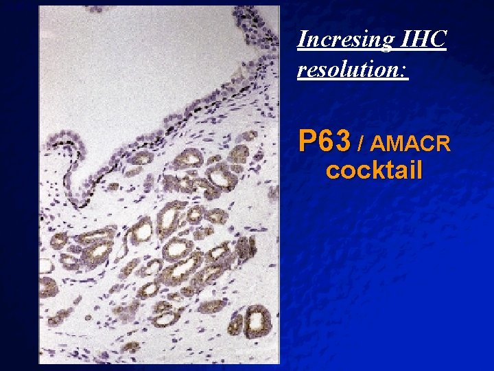 Slide 50 © 2003 By Default! Incresing IHC resolution: P 63 / AMACR cocktail Slide 50 © 2003 By Default! Incresing IHC resolution: P 63 / AMACR cocktail