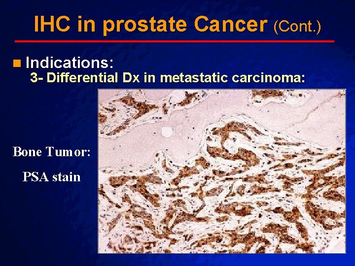 Slide 53 © 2003 By Default! IHC in prostate Cancer (Cont. ) n Indications: Slide 53 © 2003 By Default! IHC in prostate Cancer (Cont. ) n Indications: