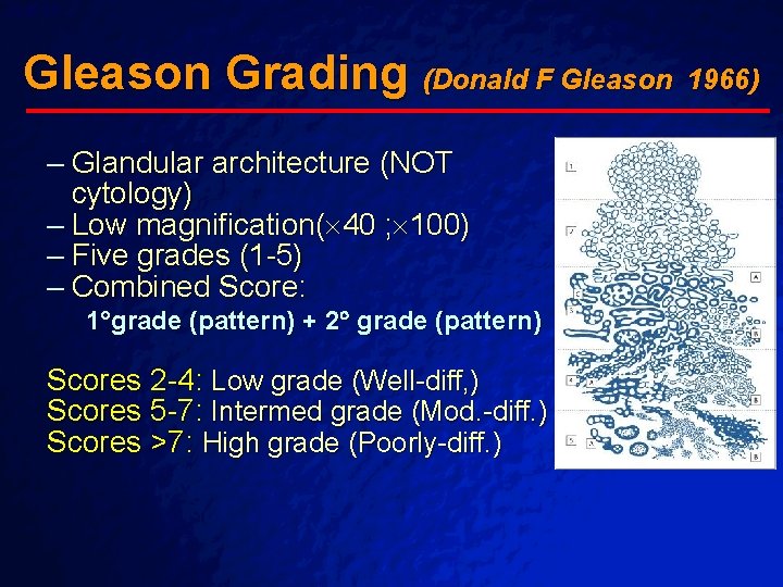Slide 55 © 2003 By Default! Gleason Grading (Donald F Gleason – Glandular architecture Slide 55 © 2003 By Default! Gleason Grading (Donald F Gleason – Glandular architecture