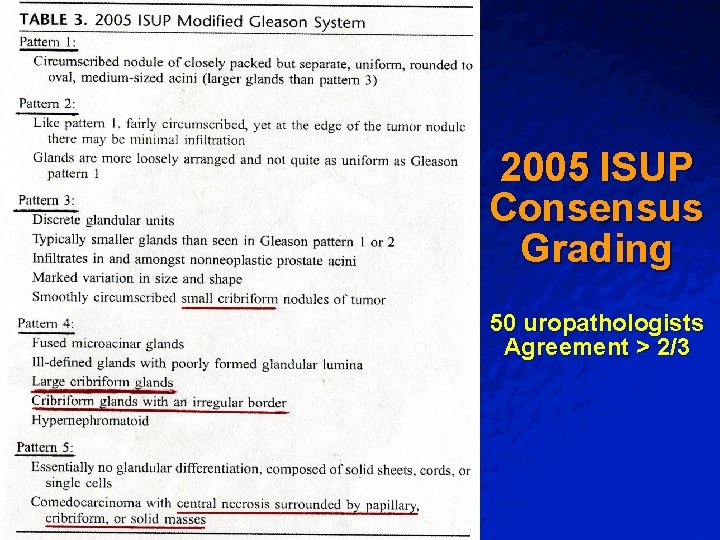 Slide 56 © 2003 By Default! 2005 ISUP Consensus Grading 50 uropathologists Agreement > Slide 56 © 2003 By Default! 2005 ISUP Consensus Grading 50 uropathologists Agreement >