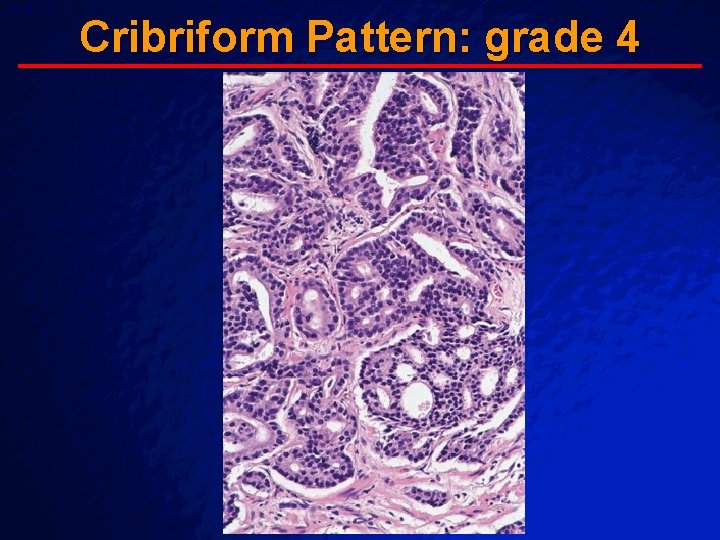Slide 60 © 2003 By Default! Cribriform Pattern: grade 4 A Free sample background Slide 60 © 2003 By Default! Cribriform Pattern: grade 4 A Free sample background