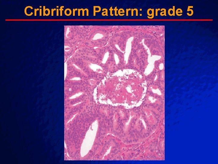 Slide 61 © 2003 By Default! Cribriform Pattern: grade 5 A Free sample background Slide 61 © 2003 By Default! Cribriform Pattern: grade 5 A Free sample background