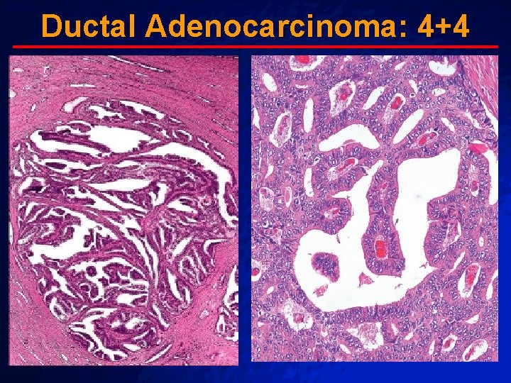 Slide 62 © 2003 By Default! Ductal Adenocarcinoma: 4+4 A Free sample background from Slide 62 © 2003 By Default! Ductal Adenocarcinoma: 4+4 A Free sample background from