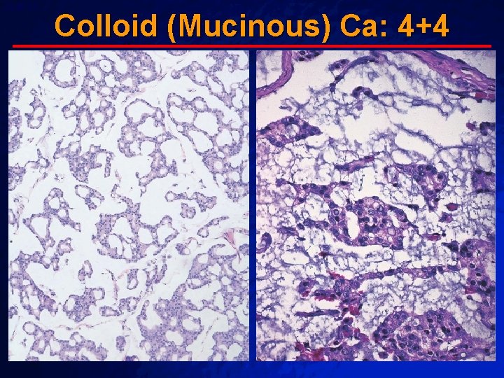 Slide 63 © 2003 By Default! Colloid (Mucinous) Ca: 4+4 A Free sample background Slide 63 © 2003 By Default! Colloid (Mucinous) Ca: 4+4 A Free sample background