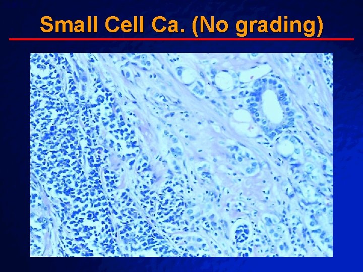 Slide 64 © 2003 By Default! Small Cell Ca. (No grading) A Free sample Slide 64 © 2003 By Default! Small Cell Ca. (No grading) A Free sample