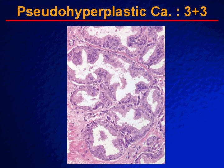 Slide 65 © 2003 By Default! Pseudohyperplastic Ca. : 3+3 A Free sample background Slide 65 © 2003 By Default! Pseudohyperplastic Ca. : 3+3 A Free sample background