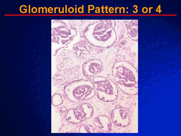 Slide 66 © 2003 By Default! Glomeruloid Pattern: 3 or 4 A Free sample Slide 66 © 2003 By Default! Glomeruloid Pattern: 3 or 4 A Free sample