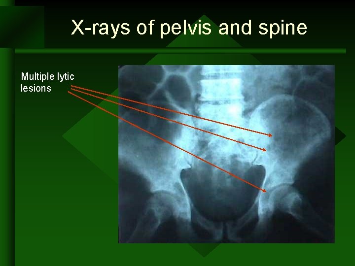 X-rays of pelvis and spine Multiple lytic lesions X-rays of pelvis and spine Multiple lytic lesions