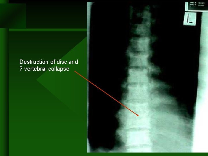 Destruction of disc and ? vertebral collapse Destruction of disc and ? vertebral collapse