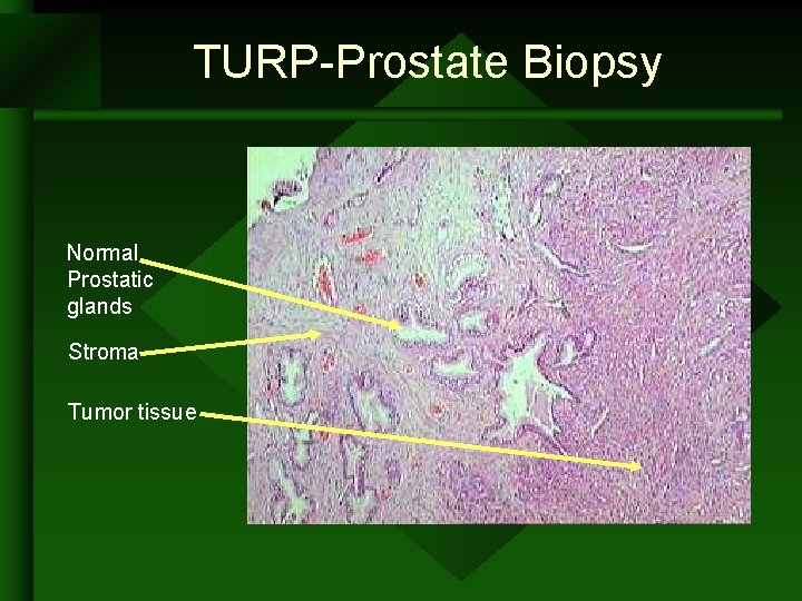 TURP-Prostate Biopsy Normal Prostatic glands Stroma Tumor tissue TURP-Prostate Biopsy Normal Prostatic glands Stroma Tumor tissue