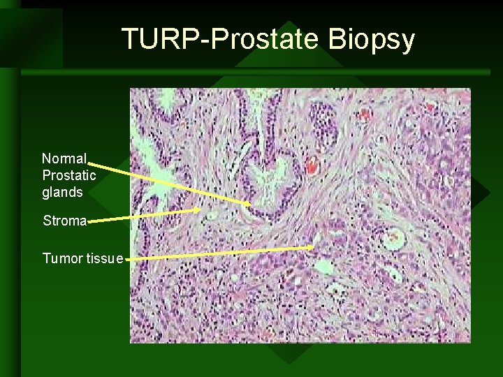 TURP-Prostate Biopsy Normal Prostatic glands Stroma Tumor tissue TURP-Prostate Biopsy Normal Prostatic glands Stroma Tumor tissue