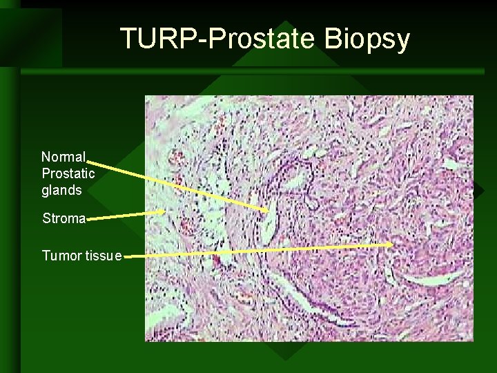 TURP-Prostate Biopsy Normal Prostatic glands Stroma Tumor tissue TURP-Prostate Biopsy Normal Prostatic glands Stroma Tumor tissue