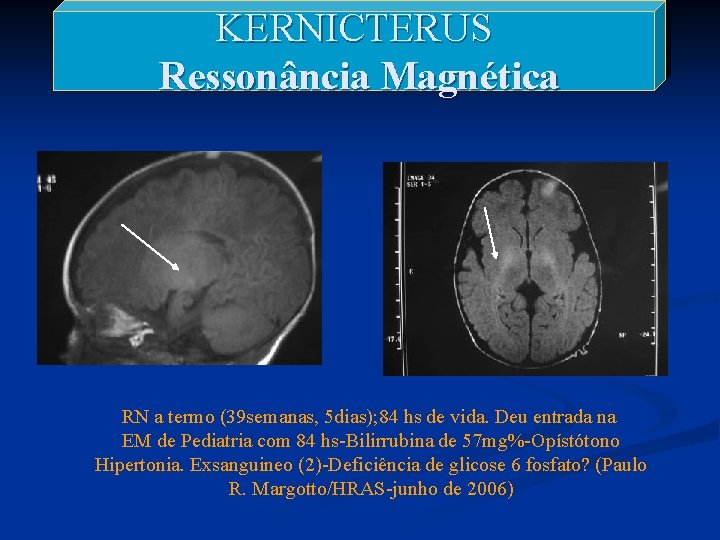 KERNICTERUS Ressonância Magnética RN a termo (39 semanas, 5 dias); 84 hs de vida.