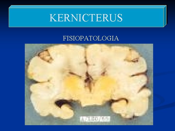 KERNICTERUS FISIOPATOLOGIA 