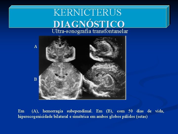 KERNICTERUS DIAGNÓSTICO Ultra-sonografia transfontanelar A B Em (A), hemorragia subependimal. Em (B), com 50