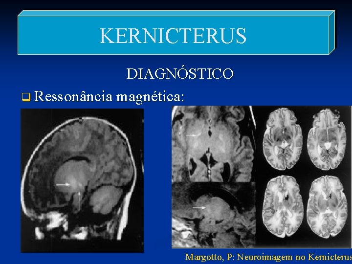 KERNICTERUS DIAGNÓSTICO q Ressonância magnética: Margotto, P: Neuroimagem no Kernicterus 